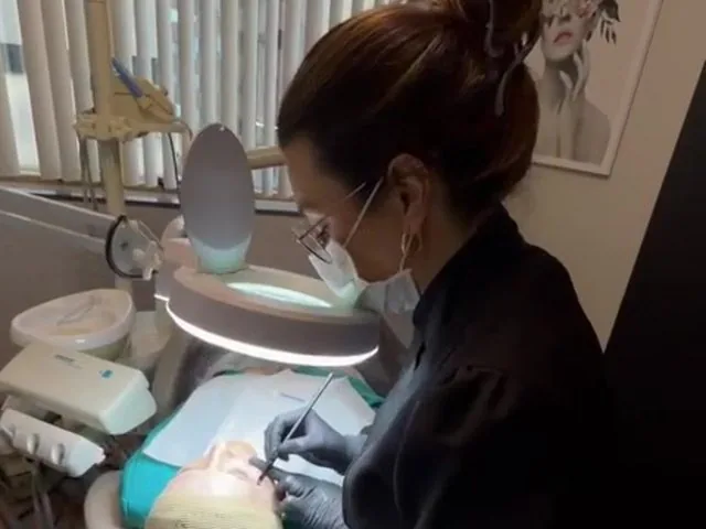 Peeling químico sendo realizado em consultório