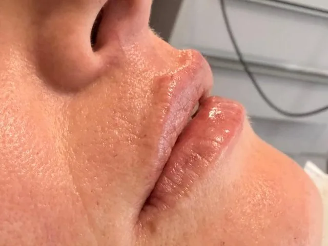 Lábios com contorno e volume naturais após preenchimento labial